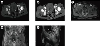 Case report: Ectopic corpus cavernosum presented as bladder tumor in a 3-year-old boy